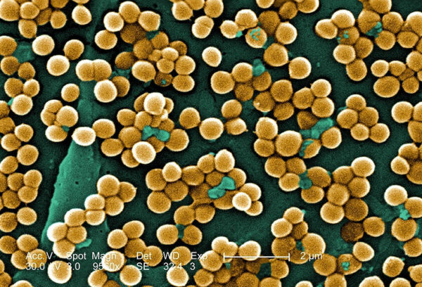 The Deadly Nature of Golden Staph